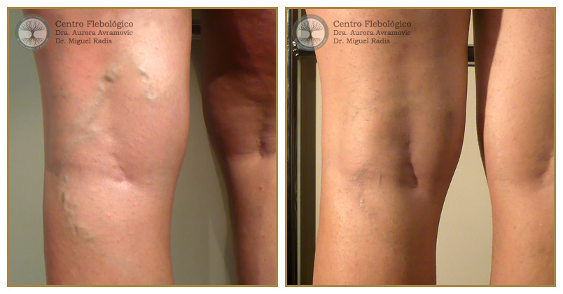 Várices en zona de hueco popliteo